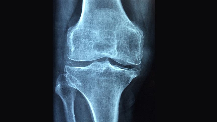 Osteoporoza bağlı kırıklar sağlık sistemine olan yükü artırıyor Osteoporoza bağlı kırıklar sağlık sistemine olan yükü artırıyor